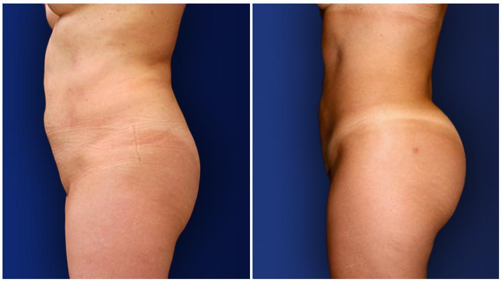 Brazilian Butt Lift - El Paso Liposuction Specialty Clinic