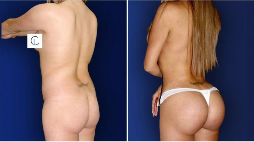 BBL Pillow After Surgery-Brazilian Butt Lift/Fat Transfer